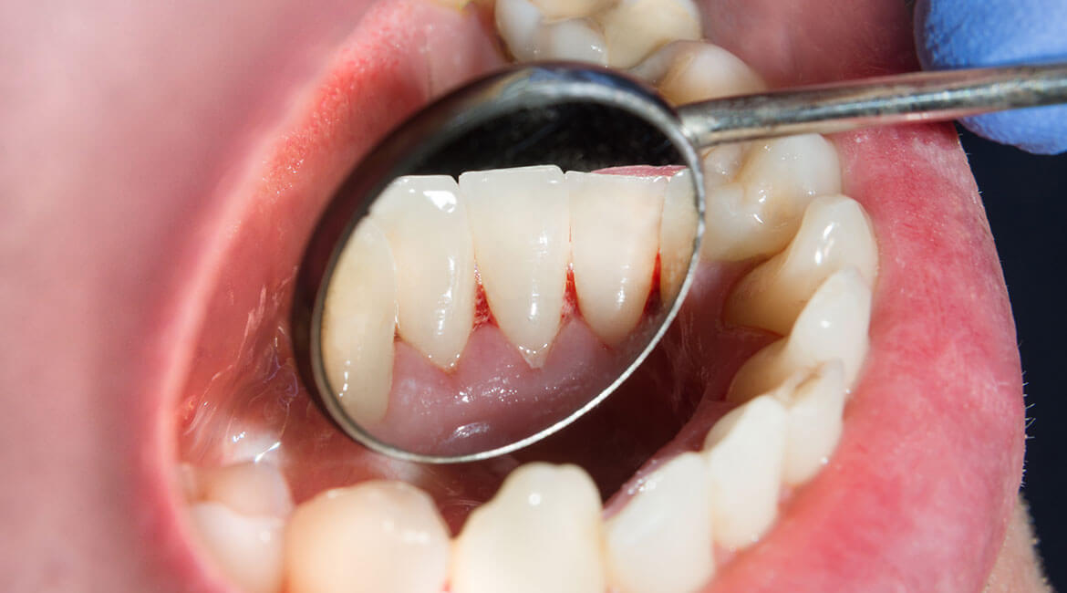 Paradontoza i sposoby jej leczenia w stomatologii