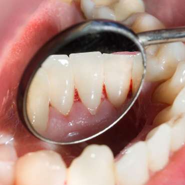 Periodontitis and methods of its treatment in dentistry