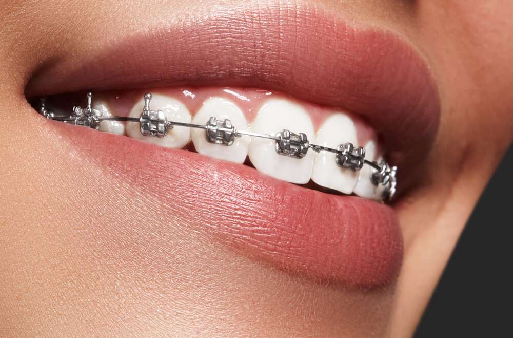 Stan dziąseł a leczenie ortodontyczne – co warto wiedzieć?